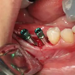Due viti per impianto dentale sono visibili nella gengiva, pronte per la guarigione. Il dolore post-operatorio è comune, ma gestibile.