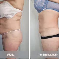 Liposukcja: Co to, metody, efekty i koszty? Pełny przewodnik!