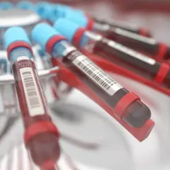 Probówki z krwią w wirówce laboratoryjnej. Wyniki badań wskazują na podwyższone bazocyty, co może wymagać dalszej diagnostyki.