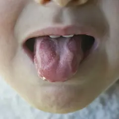 Lingua di bambino con piccole vescicole, possibile sintomo di stomatite.