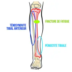 Schéma du tibia montrant les causes de douleur : fracture de fatigue, périostite tibiale et ténosynovite du tibial antérieur.