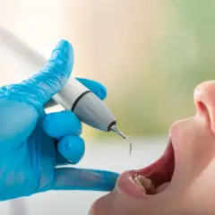 Dentysta w niebieskiej rękawiczce używa ultradźwiękowego skalera. Czy usuwanie kamienia boli? Zabieg jest zazwyczaj bezbolesny.