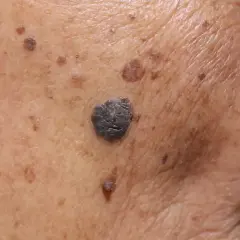 Zbliżenie na skórę z licznymi, ciemnymi i jasnymi, suche plamy na skórze, w tym duży, ciemny znamień.
