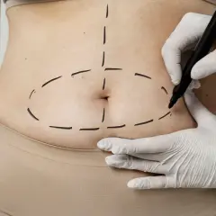 Liposukcja brzucha: Modelowanie czy odchudzanie? Poznaj prawdę!