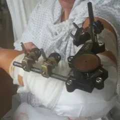 Ein Arm mit einem externen Fixateur, der für die Heilung nach einer Verletzung angelegt wurde. Dieses **halo medizin** Gerät stabilisiert den Knochen.