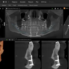 CBCT co to? Obraz przedstawia skany 3D szczęki i żuchwy z implantami, pokazujące szczegółową anatomię kości i zębów.