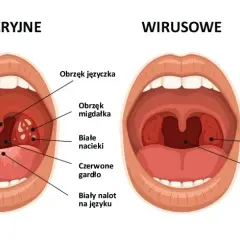 Jakie leki na anginę ropną? Skuteczne metody leczenia i ulgi