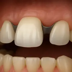 Un ponte dentale incollato, con una struttura metallica che collega i denti naturali, ripristina un sorriso completo.