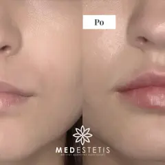 Kwas hialuronowy do ust: jak wybrać najlepszy dla naturalnego efektu?