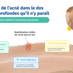 Illustration expliquant les causes de l'acné du dos chez l'adolescent : facteurs génétiques, hormonaux et hygiéniques.