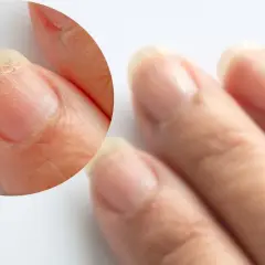 Paznokcie z łuszczącą się płytką, mogą być jednym z objawów wysokiego cholesterolu.
