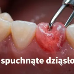 Opuchnięte dziąsła: Szybka ulga w domu i kiedy do dentysty?