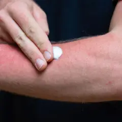 Mann trägt Salbe auf stark geröteten Arm auf, der unter brennender Haut leidet.