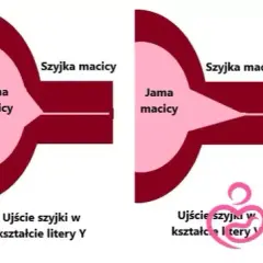 Skracanie szyjki macicy przed porodem: objawy, tempo, kiedy do lekarza?
