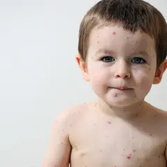 Bambino con macchie rosse sul viso e sul corpo, tipiche delle malattie esantematiche infantili.