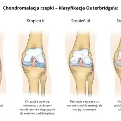 Klasyfikacja Outerbridge'a pokazuje cztery stopnie chondromalacji rzepki: od zmiękczenia chrząstki (stopień I) do odsłonięcia kości (stopień IV).