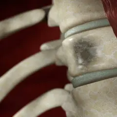 Detailansicht der Wirbelsäule mit Läsionen, die auf multiples Myelom hindeuten. Knochenstruktur ist porös.