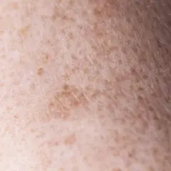 Zbliżenie na skórę z przebarwieniami, gdzie widać nierównomierne rozmieszczenie melaniny. To właśnie melanina co to jest, decyduje o kolorze skóry.