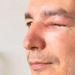 Un homme souffre d'une conjonctivite, son œil est visiblement gonflé et irrité.
