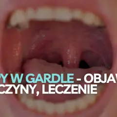 Widok otwartych ust z widocznymi migdałkami i językiem. Tekst informuje o polipach w gardle, objawach i leczeniu.