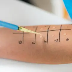 Test skórny sprawdzający, czy miód uczula. Na przedramieniu zaznaczono pola z numerami, na które aplikowane są substancje.