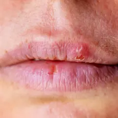Labbra secche e screpolate, con piccole lesioni e desquamazione, possibili sintomi di diabete.
