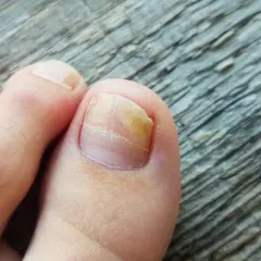Uña del dedo gordo del pie con hongos, amarillenta y engrosada.