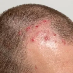 Närbild på en mans huvud med utslag och rodnad som kan tyda på rosacea i hårbotten.