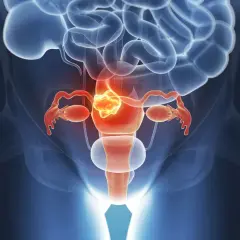 Illustration des weiblichen Beckens mit Fokus auf die Gebärmutter, die einen Tumor zeigt. Dies illustriert die Leitlinie Endometriumkarzinom.