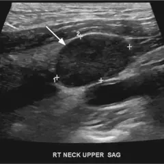 Ultraschallbild des Halses zeigt einen unauffälligen Lymphknoten mit Markierungen zur Größenmessung.