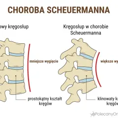 Porównanie zdrowego kręgosłupa z kręgosłupem w chorobie Scheuermanna. Widoczne klinowate kręgi i większe wygięcie.