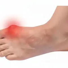 Piede con alluce valgo e arrossamento, indicativo di dolore alluce pressione.