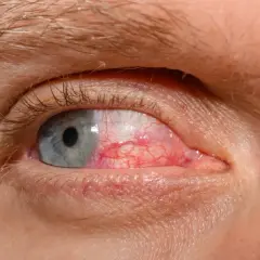 Silne przekrwienie oka, widoczne liczne naczynia krwionośne. Prawdopodobnie odczuwane jest kłucie w oku.