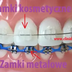 Aparat na zęby: zobacz, jak wygląda! Od metalu po niewidoczne