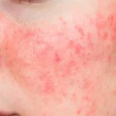 Rostro con enrojecimiento y pequeños bultos, indicativo de rosacea leve.