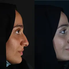 Przed i po: subtelna rhinoplastyka co to jest? Zmiana profilu nosa, poprawa harmonii twarzy.