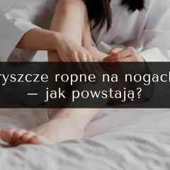 Pryszcze na nogach: przyczyny, skuteczne metody leczenia i profilaktyka