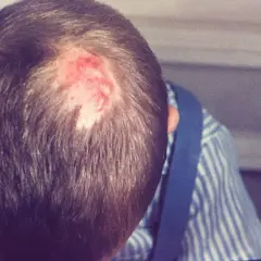 Röd, irriterad fläck på en persons huvud, där håret är tunt. Det kan vara svamp i hårbotten.