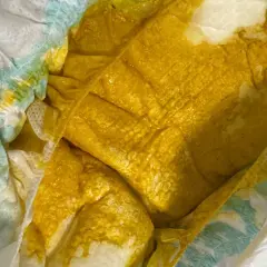 Pannolino con feci gialle e liquide, indicative di diarrea neonato. La consistenza è molto morbida e acquosa.