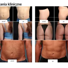 Badania kliniczne pokazują spektakularne trening ems efekty przed i po: widoczna redukcja tkanki tłuszczowej na brzuchu i pośladkach.