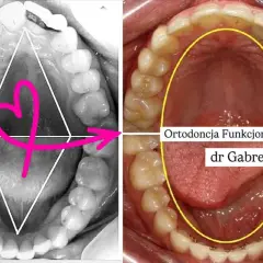 Ortodoncja przed i po: porównanie uzębienia. Po lewej zdjęcie z geometrycznymi oznaczeniami, po prawej efekt leczenia dr Gabren.