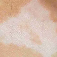 Pelle con macchie bianche e rosa, tipiche del nevo di Sutton nei bambini.
