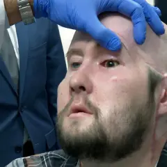 Lekarz w niebieskiej rękawiczce bada oko pacjenta po przeszczepie.