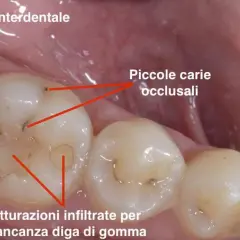 Denti con carie interdentale e occlusale, otturazioni infiltrate. Una situazione che può causare una sgradevole puzza tra i denti.