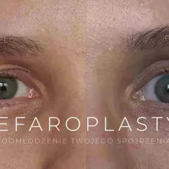 Przed i po zabiegu blefaroplastyki powiek. Zobacz, jak odmłodzić spojrzenie i dowiedz się, jaka jest blefaroplastyka powiek cena.