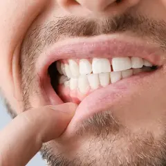 Primo piano di un uomo che mostra i denti e le gengive. Si nota un dito che solleva il labbro, evidenziando le gengive ritirate.