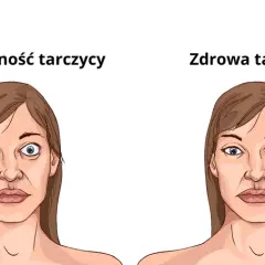 Objawy nadczynności tarczycy u osób starszych - jak je rozpoznać?