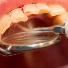 Dentysta usuwa kamień z zębów ultradźwiękami. Skuteczny sposób, jak pozbyć się kamienia na zębach, by mieć piękny uśmiech.