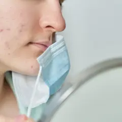 Primo piano di un viso con evidenti segni di acne da mascherina. La persona tiene una mascherina blu e bianca vicino al mento.