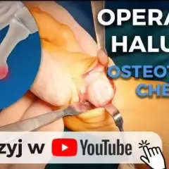 Operacja haluksów: Wybierz klinikę i metodę. Poradnik.